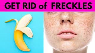 how to get rid of freckles Naturally fast  Proven Home remedies [upl. by Atalayah]