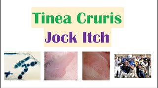 Jock Itch Tinea Cruris  Causes Risk Factors Signs amp Symptoms Diagnosis and Treatment [upl. by Anayd]