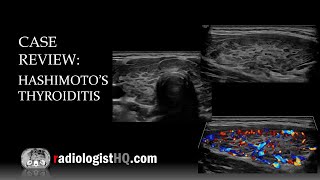 Ultrasound of Hashimoto’s Thyroiditis [upl. by Ragland]