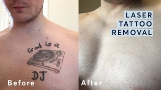 Laser Tattoo Removal  Before and After through all the stages [upl. by Samanthia]