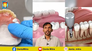 ಹಲ್ಲು ಕಟುವುದು prosthodontic implantdenture removabledenture dentalbridge [upl. by Quill246]