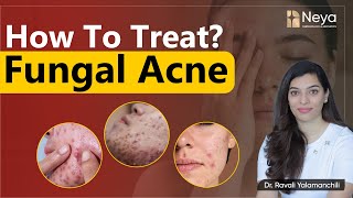 Causes of fungal acne on Face  How to treat fungal acne  Acne treatment in hyderabad [upl. by Suirad]