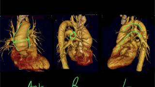 Mediastinal CXR anatomy [upl. by Estele]