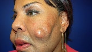 Cosmetic Surgery Disaster Woman Dubbed Cement Face Given New Lease Of Life [upl. by Timon]