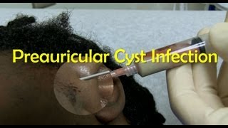 Preauricular Cyst Infection Management [upl. by Jackqueline786]