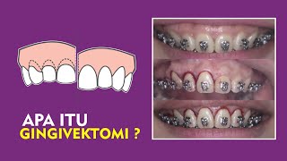 GINGIVEKTOMI Perawatan untuk Memperbaiki Gummy Smile [upl. by Rahal]