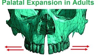 Is Palatal Expansion Possible In Adults By Dr Mike Mew [upl. by Aubin]