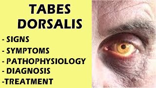 Tabes Dorsalis  Neurosyphilis Tabes Dorsalis  Tabes Dorsalis Signs amp Symptoms medicine [upl. by Sido]