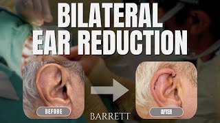 Natural Looking Ear Reduction From Start To Finish  Barrett [upl. by Raffin]