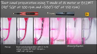 Curved root canal preparation for MTA obturation using Tmode of Ai motorAiモーターのTモードを使用して湾曲根管の根管形成 [upl. by Barbarese]