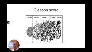 Prostate Cancer Grading and Staging [upl. by Irrab]