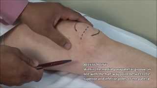 Knee Injection  Medial Approach [upl. by Nylirac592]