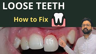 Why Your Teeth Feel LOOSE amp How to Treat TOOTH Mobility [upl. by Oikim]