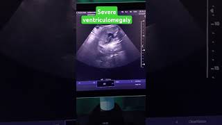 ventriculomegaly ultrasound usg pregnancy anomaly [upl. by Allimrac]