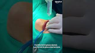 ¡Dale forma a tu sonrisa ✨ Descubre cómo la gingivectomía transforma tus encías 🤯 [upl. by Akili264]