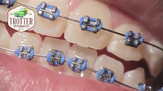 Watch How Braces Are Put On  Orthodontic Treatment Using Fixed Brackets Redondo Beach Orthodontist [upl. by Goulette554]