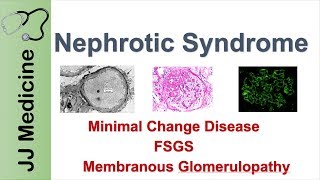 Nephrotic Syndrome  Clinical Presentation Causes and Treatment [upl. by Aivekahs]