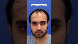 Hair Transplant Results  4000 Grafts Hair Transplant  Medlinks hairtransplantresults shortsfeed [upl. by Anitnatsnok301]