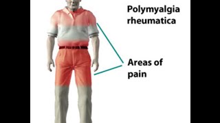 Polymyalgia Rheumatica [upl. by Nordine]