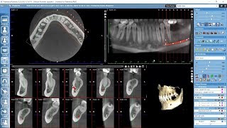 Working with crosssections in Planmeca Romexis 3D module [upl. by Nogas]