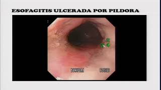 5 Úlceras en esófago Diagnóstico diferencial [upl. by Noscire]