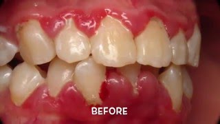 Treatment of Periodontal Gum Disease [upl. by Anival]