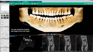 Clinical Case  Ez3Di  Endodontic Treatment C shaped Root Canal Case [upl. by Aelsel]