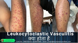 Leukocytoclastic Vasculitis  sudden red rashes  red spot on leg palpable purpura Dr Uttam Lenka [upl. by Dewar]