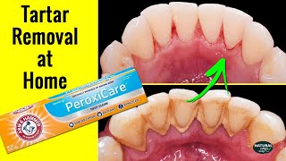 Best Toothpaste for Tartar Removal  Remove Tartar Buildup Fast Naturally  Dental Hygiene [upl. by Dranyl]