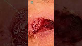 What is squamous cell carcinoma  Shorts [upl. by Orazal]