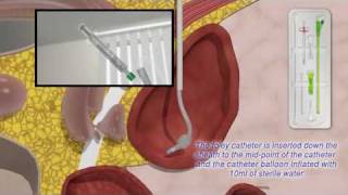 Mediplus Ltd  SCath TM System Inserting a Foley catheter suprapubically [upl. by Quita]