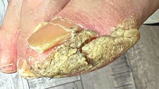 Trimming Extremely THICK And Cracked Callus [upl. by Gnouv]