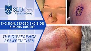 The Difference Between Excision Staged Excision amp Mohs Surgery for removing skin cancer [upl. by Amairam]