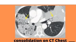 consolidation right upper Lob  right plural effusion [upl. by Yrocej8]