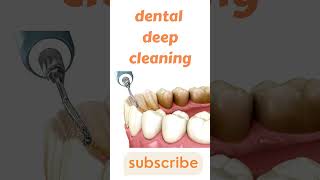 Dental Deep Teeth Cleaning Procedure before and after with heavy tartar 3d animated video dentist [upl. by Bainbridge]