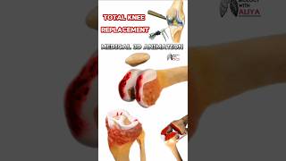 ELEGANT® MULTI LOCKING TIBIA NAIL  Sharma orthopedic [upl. by Anirb108]