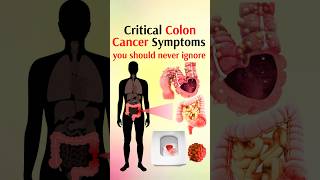 Critical colon cancer symptoms shorts [upl. by Durr]