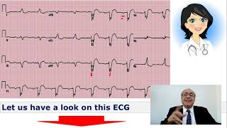 EKG Trainer Case 3 Answer [upl. by Zednanref529]