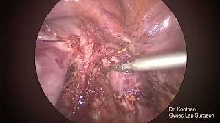 Complete Bicorporeal uterus with septate cervix with Rectovesical fusion [upl. by Annaliese]