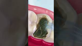 Teeth cavity treatment  teeth filling teeth dental problem [upl. by Sualohcin]