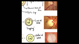 Normal Disc vs Glaucomatous Disc vs Atrophic Disc Basics Shorts [upl. by Dimah]