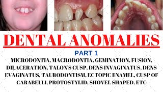 Developmental disturbances in teeth  Dental anomalies  Odontology notes  UGC NET Forensic science [upl. by Irahk768]