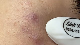 Acne treatment for Spa Linh Mun 2023 072 [upl. by Dugan115]