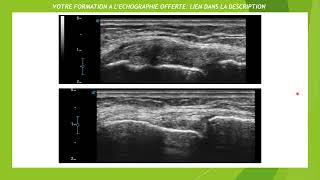 Echographie dune entorse médiale du genou [upl. by Rogers]