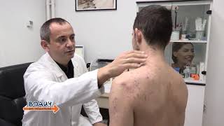 Akne  Dr Dimitrije Karabahčiev dermatovenerolog  Dermamedicus Beograd [upl. by Melise445]