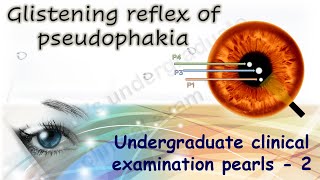 Glistening reflex in pseudophakia Undergraduate Clinical Examination Pearls 2 [upl. by Ecilef722]