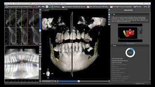 Making Your First Surgical Guide From A to Z [upl. by Ryle110]