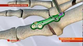 ORTHOLOC™ 3Di Foot Reconstruction System MTP Fusion Plate Animation [upl. by Pelmas]