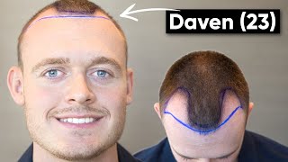 Geheimratsecken mit 23 Jahren  Davens Haartransplantation im Memorial [upl. by Nilyaj608]