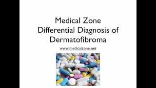 Medical Zone  Differential Diagnosis of Dermatofibroma [upl. by Glory]